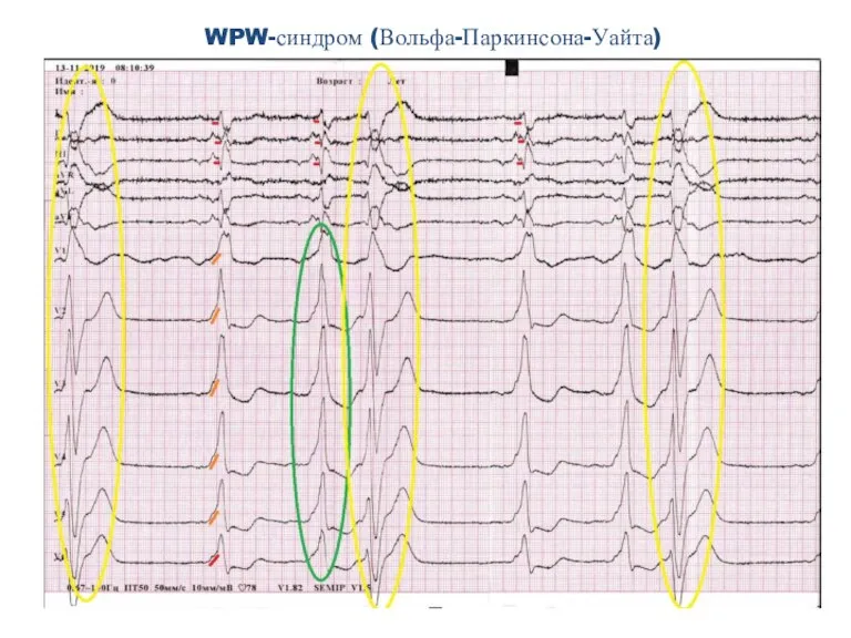 WPW-синдром (Вольфа-Паркинсона-Уайта)