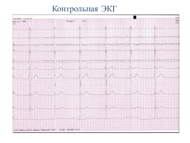 Контрольная ЭКГ