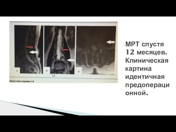 МРТ спустя 12 месяцев.Клиническая картина идентичная предоперационной.