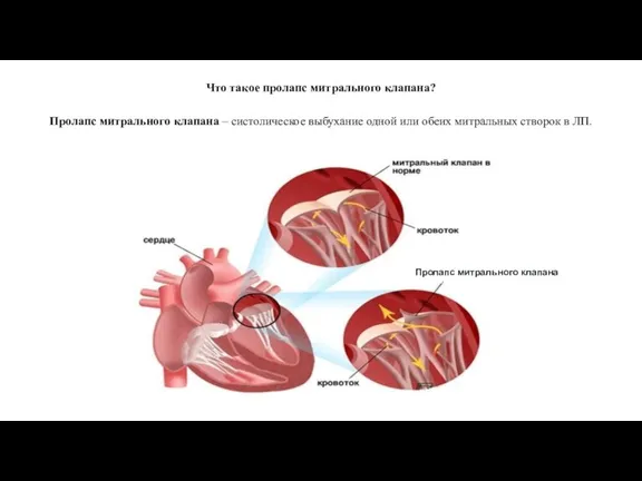 Пролапс митрального клапана – систолическое выбухание одной или обеих митральных створок в