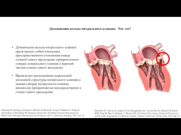 Дизъюнкция кольца митрального клапана. Что это? Essayagh B, Sabbag A, Antoine C,