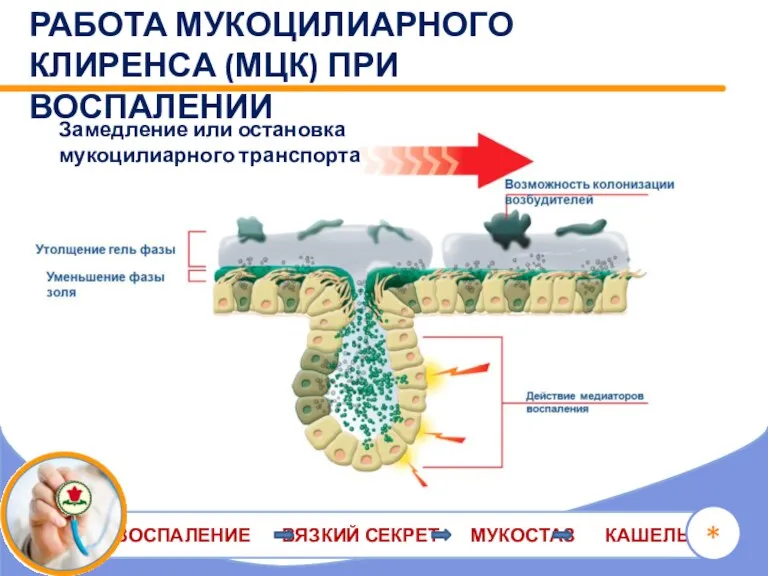 ВОСПАЛЕНИЕ ВЯЗКИЙ СЕКРЕТ МУКОСТАЗ КАШЕЛЬ * РАБОТА МУКОЦИЛИАРНОГО КЛИРЕНСА (МЦК) ПРИ ВОСПАЛЕНИИ