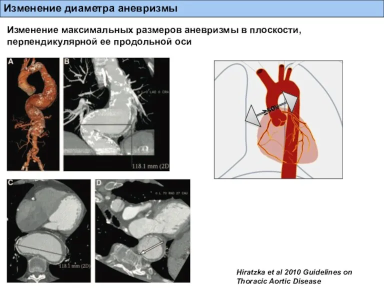 Изменение диаметра аневризмы Изменение максимальных размеров аневризмы в плоскости, перпендикулярной ее продольной