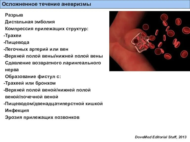 Осложненное течение аневризмы Разрыв Дистальная эмболия Компрессия прилежащих структур: Трахеи Пищевода Легочных