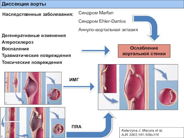 Наследственные заболевания: Синдром Marfan Синдром Ehler-Danlos Аннуло-аортальная эктазия Дегенеративные изменения Атеросклероз Воспаление