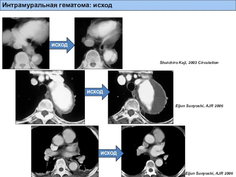 Shuichiro Kaji, 2003 Circulation Eijun Sueyoshi, AJR 2006 Eijun Sueyoshi, AJR 2006 Интрамуральная гематома: исход