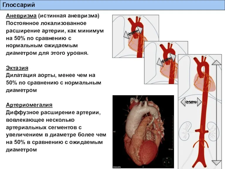 Глоссарий Аневризма (истинная аневризма) Постоянное локализованное расширение артерии, как минимум на 50%