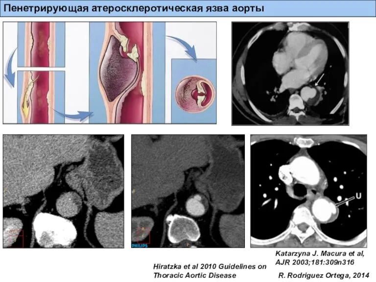 Katarzyna J. Macura et al, AJR 2003;181:309n316 R. Rodriguez Ortega, 2014 Пенетрирующая