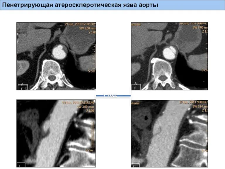 1 год Пенетрирующая атеросклеротическая язва аорты