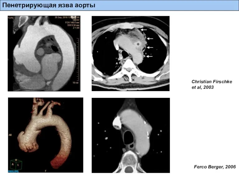 Christian Firschke et al, 2003 Ferco Berger, 2006 Пенетрирующая язва аорты