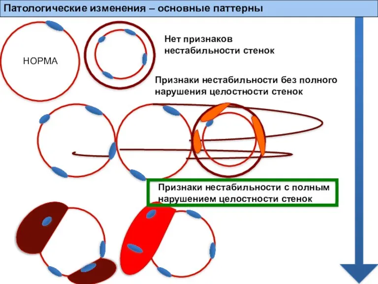 Патологические изменения – основные паттерны Нет признаков нестабильности стенок Признаки нестабильности без