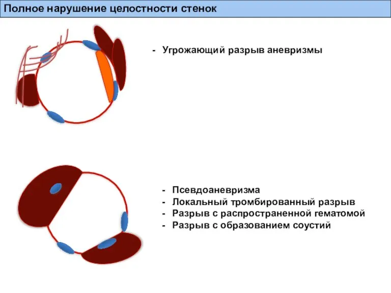 Угрожающий разрыв аневризмы Псевдоаневризма Локальный тромбированный разрыв Разрыв с распространенной гематомой Разрыв