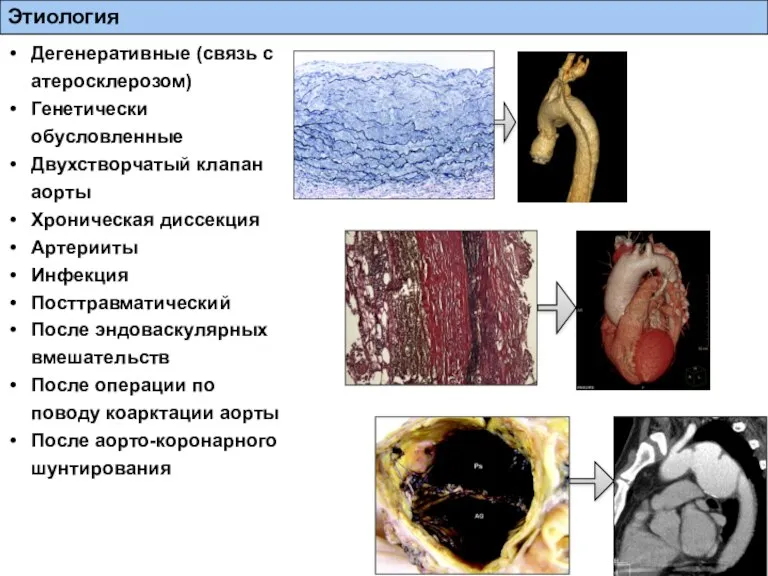Этиология Дегенеративные (связь с атеросклерозом) Генетически обусловленные Двухстворчатый клапан аорты Хроническая диссекция