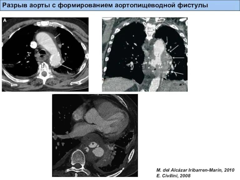 Разрыв аорты с формированием аортопищеводной фистулы M. del Alcázar Iribarren-Marín, 2010 E. Civilini, 2008