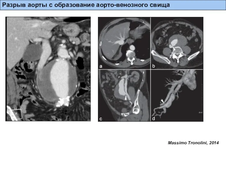 Разрыв аневризмы с образованием свищей и соустий Massimo Tronolini, 2014 Разрыв аорты с образование аорто-венозного свища