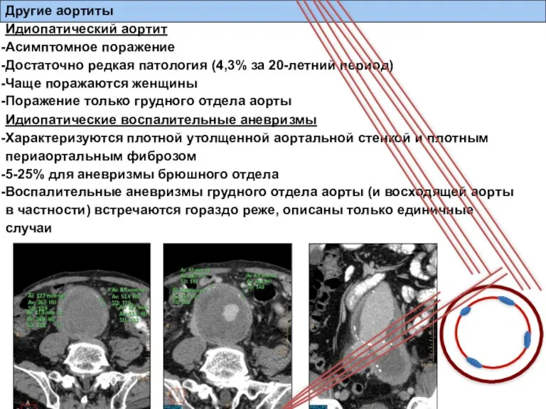 Идиопатический аортит Асимптомное поражение Достаточно редкая патология (4,3% за 20-летний период) Чаще