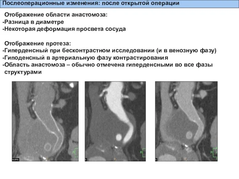 Послеоперационные изменения: после открытой операции Отображение области анастомоза: Разница в диаметре Некоторая