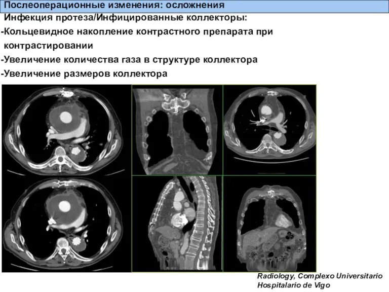 Послеоперационные изменения: осложнения Radiology, Complexo Universitario Hospitalario de Vigo Инфекция протеза/Инфицированные коллекторы: