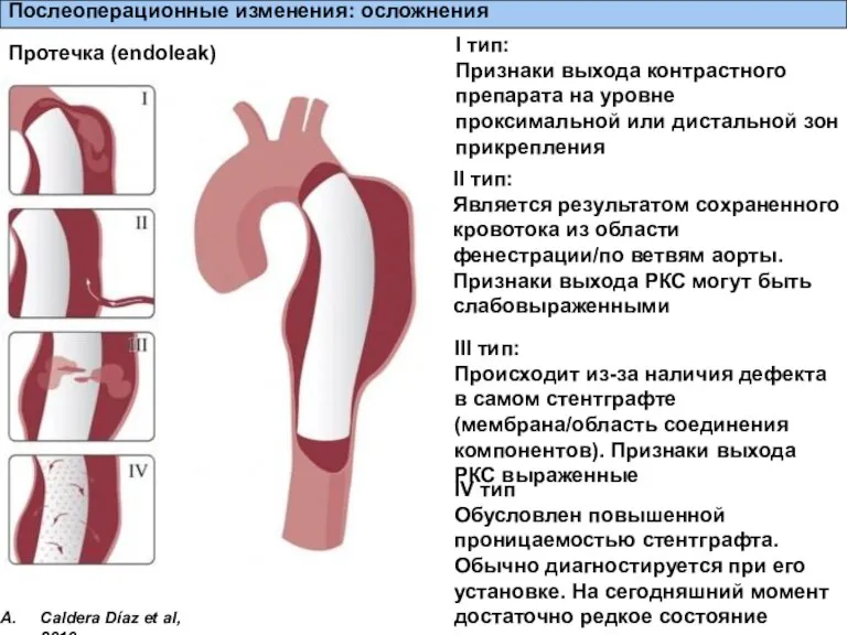 Послеоперационные изменения: осложнения Протечка (endoleak) I тип: Признаки выхода контрастного препарата на