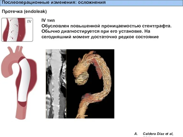 Послеоперационные изменения: осложнения Протечка (endoleak) IV тип Обусловлен повышенной проницаемостью стентграфта. Обычно