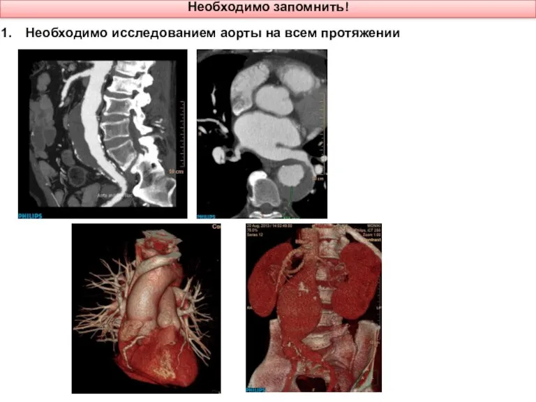 Необходимо запомнить! Необходимо исследованием аорты на всем протяжении