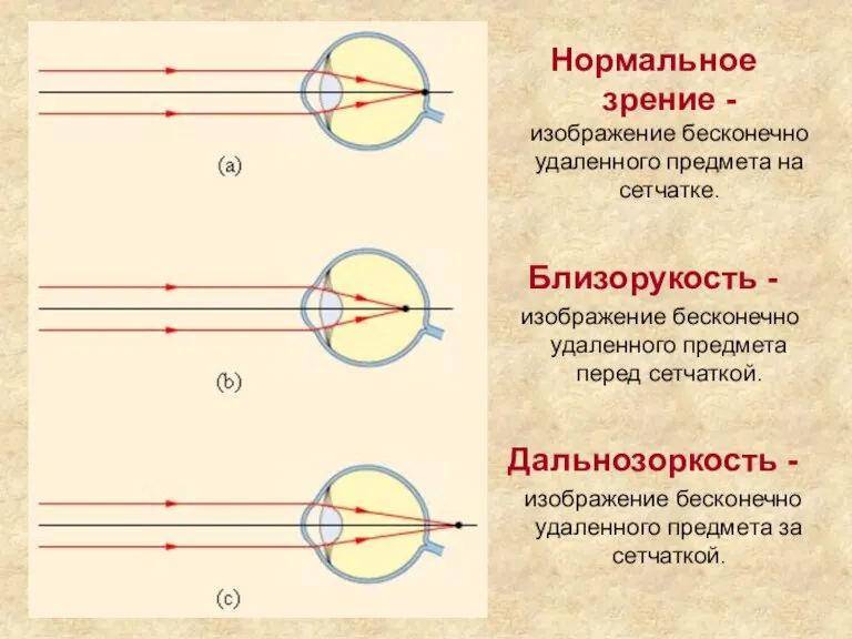 Нормальное зрение - изображение бесконечно удаленного предмета на сетчатке. Близорукость - изображение