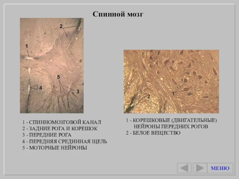 1 - КОРЕШКОВЫЕ (ДВИГАТЕЛЬНЫЕ) НЕЙРОНЫ ПЕРЕДНИХ РОГОВ 2 - БЕЛОЕ ВЕЩЕСТВО 1