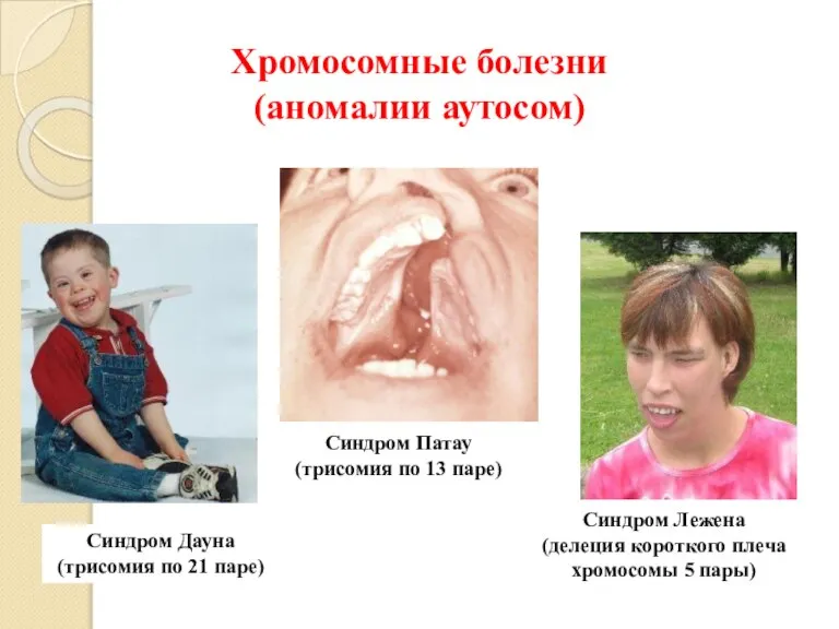 Хромосомные болезни (аномалии аутосом) Синдром Дауна (трисомия по 21 паре) Синдром Лежена