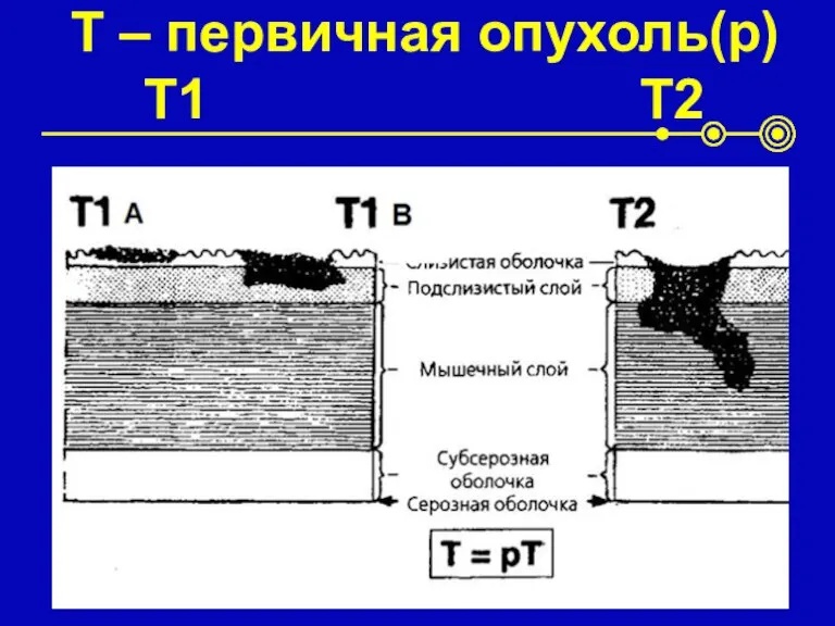 T – первичная опухоль(p) T1 T2