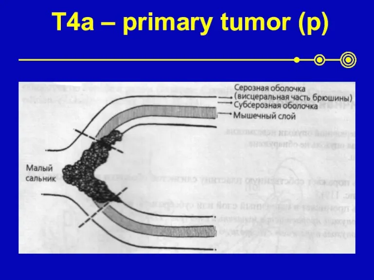 T4а – primary tumor (p)