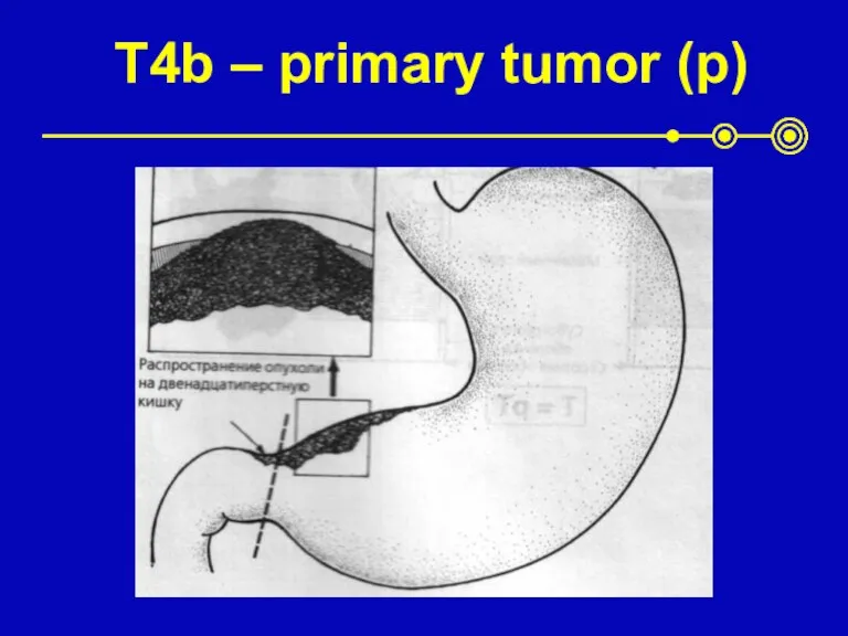 T4b – primary tumor (p)