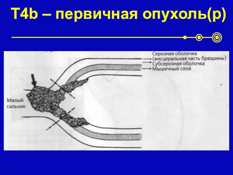 T4b – первичная опухоль(p)