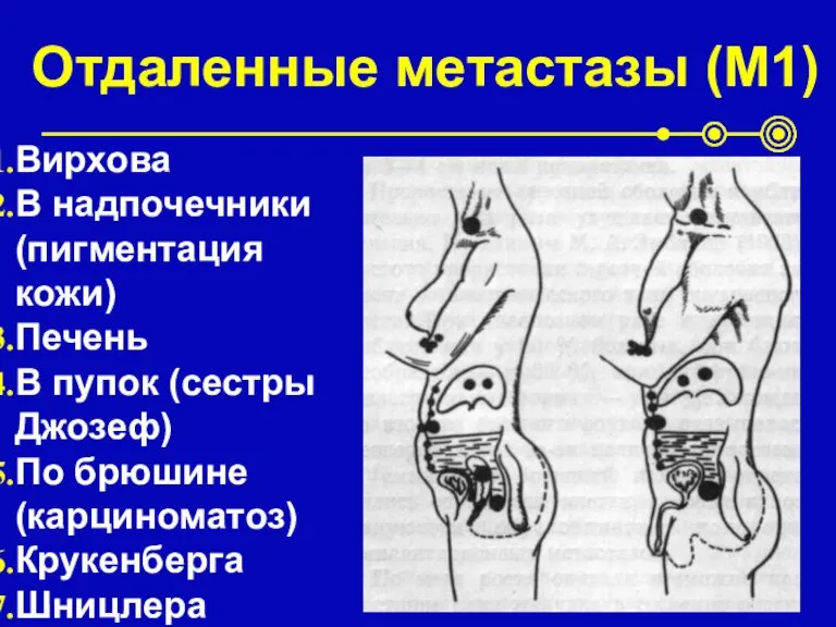 Отдаленные метастазы (М1) Вирхова В надпочечники (пигментация кожи) Печень В пупок (сестры