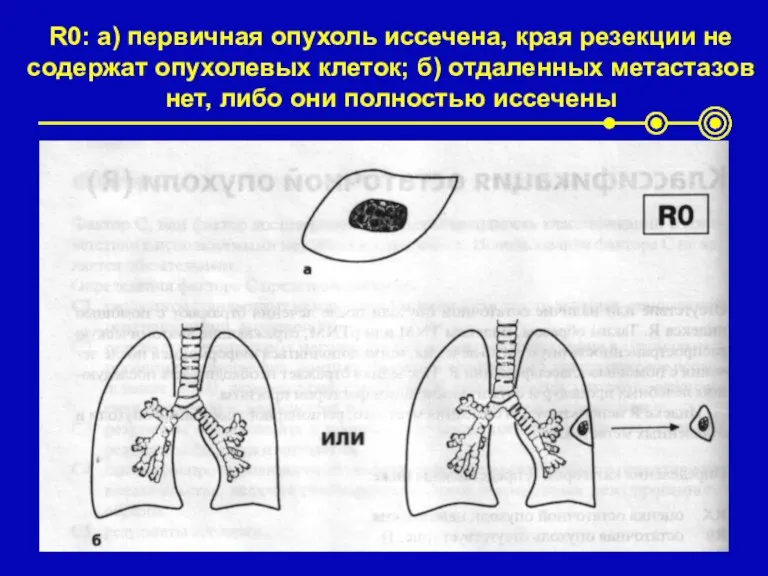 R0: а) первичная опухоль иссечена, края резекции не содержат опухолевых клеток; б)