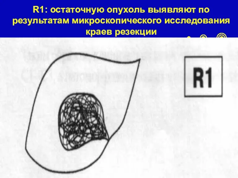 R1: остаточную опухоль выявляют по результатам микроскопического исследования краев резекции