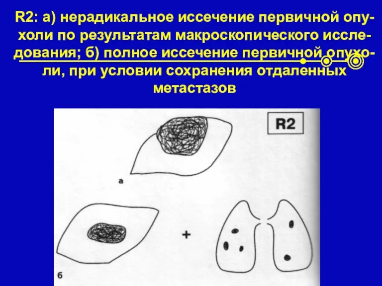 R2: а) нерадикальное иссечение первичной опу-холи по результатам макроскопического иссле-дования; б) полное