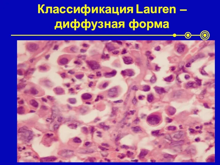 Классификация Lauren – диффузная форма