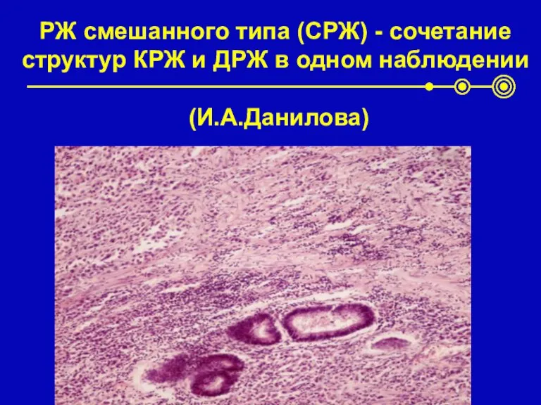 РЖ смешанного типа (СРЖ) - сочетание структур КРЖ и ДРЖ в одном наблюдении (И.А.Данилова)