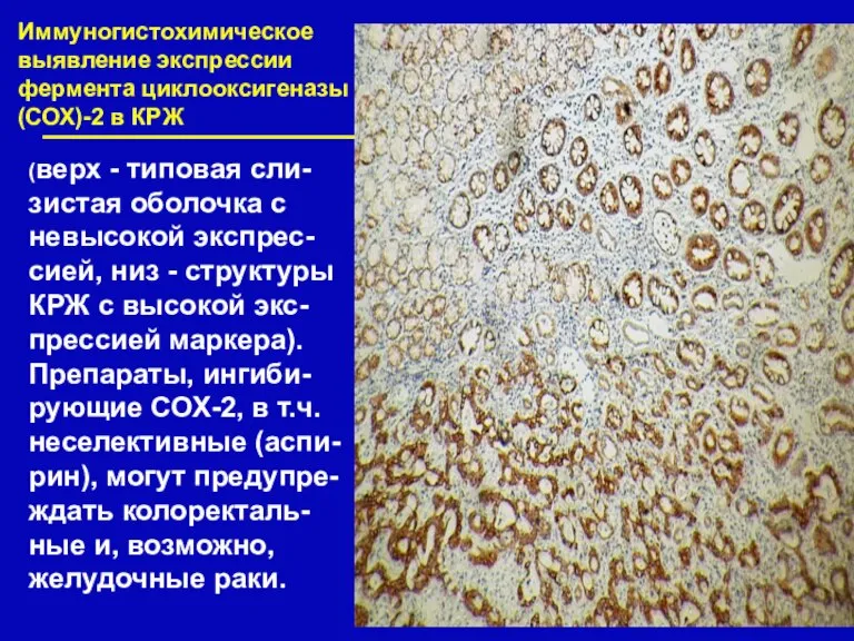 Иммуногистохимическое выявление экспрессии фермента циклооксигеназы (СОХ)-2 в КРЖ (верх - типовая сли-зистая