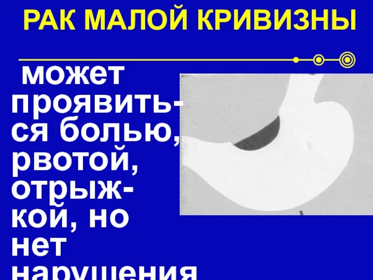 РАК МАЛОЙ КРИВИЗНЫ может проявить- ся болью, рвотой, отрыж- кой, но нет нарушения эвакуации