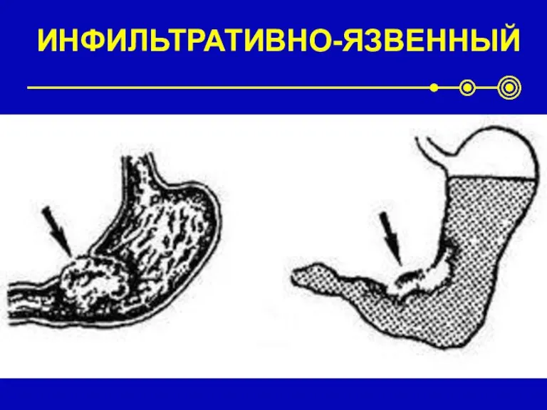 ИНФИЛЬТРАТИВНО-ЯЗВЕННЫЙ