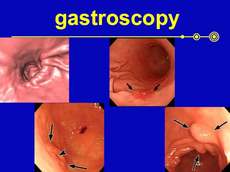 gastroscopy