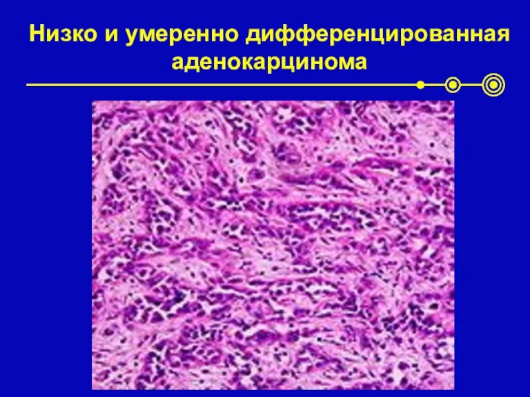 Низко и умеренно дифференцированная аденокарцинома