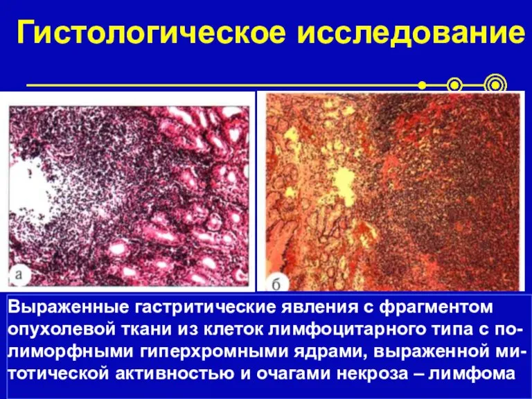 Гистологическое исследование Выраженные гастритические явления с фрагментом опухолевой ткани из клеток лимфоцитарного