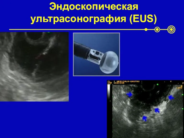 Эндоскопическая ультрасонография (EUS)