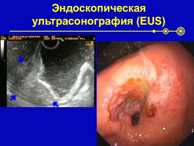 Эндоскопическая ультрасонография (EUS)