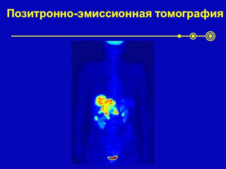 Позитронно-эмиссионная томография