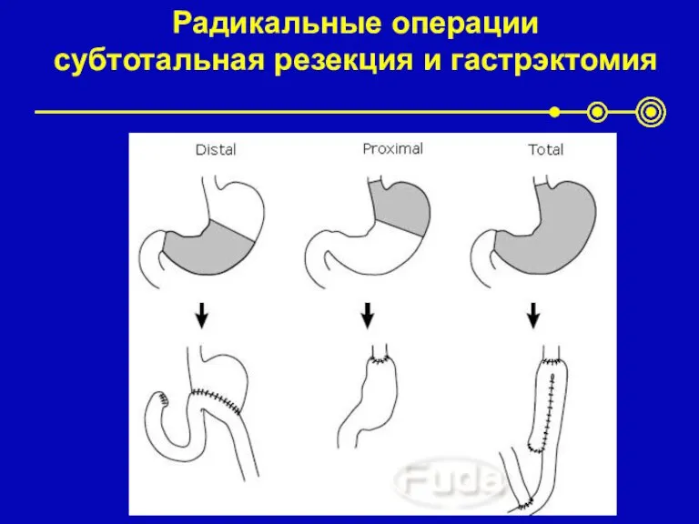 Радикальные операции субтотальная резекция и гастрэктомия