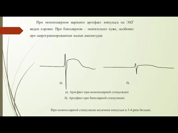 При монополярном варианте артефакт импульса на ЭКГ виден хорошо. При биполярном –