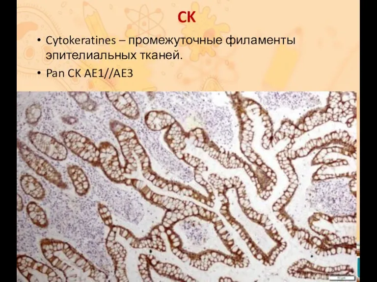 CK Cytokeratines – промежуточные филаменты эпителиальных тканей. Pan CK AE1//AE3